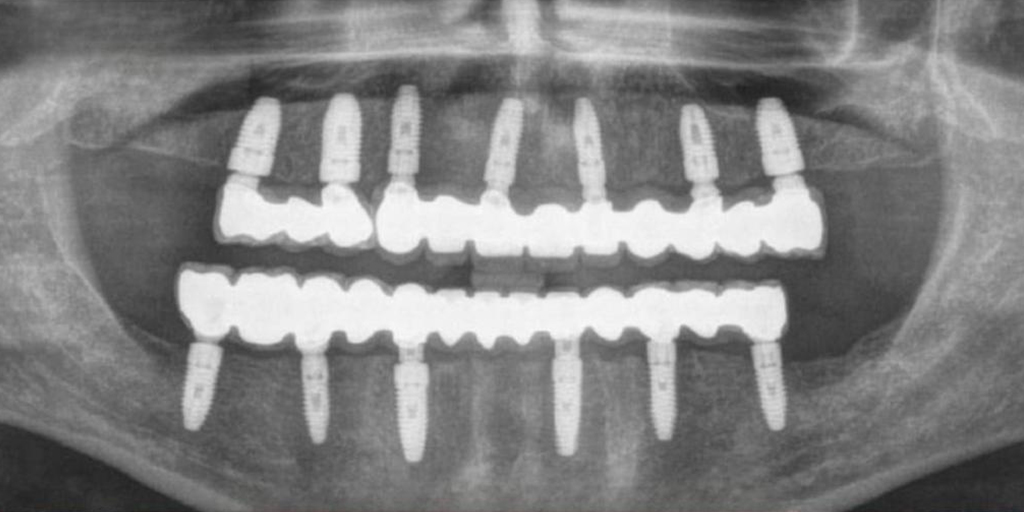 dental-implant-11