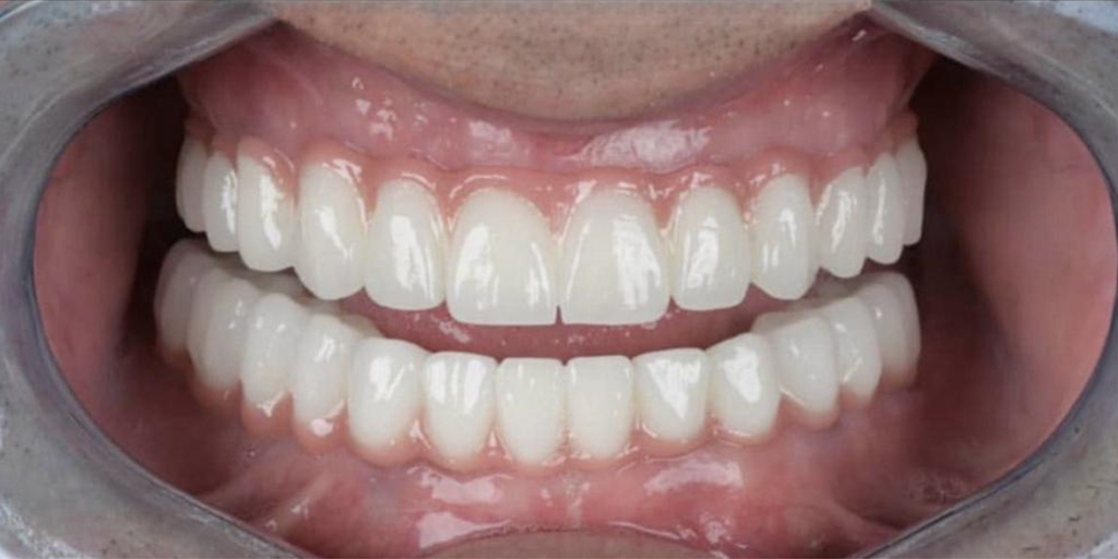 dental-implant-12